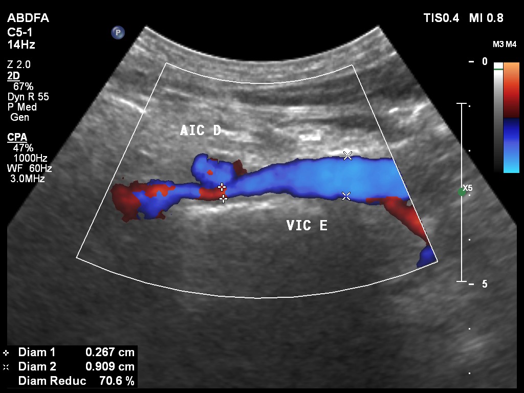 A TIPIC Ultrasonographic B-Mode Imaging of the Common Carotid