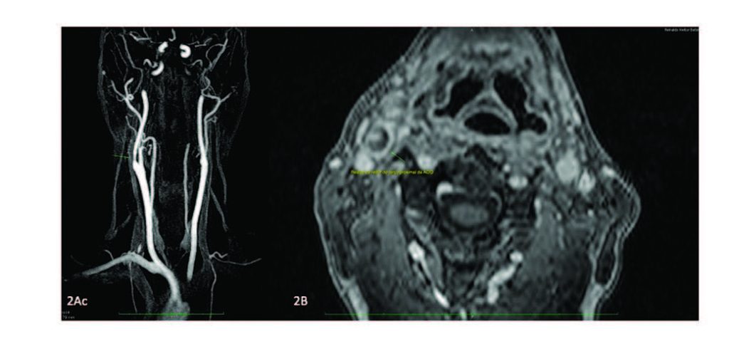 Inflamação Perivascular Transitória da Artéria Carótida (TIPIC): Papel da Ultrassonografia Vascular